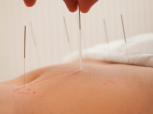 Pratique de l&rsquo;appareil des points d’acupuncture sans connaissance des méridiens